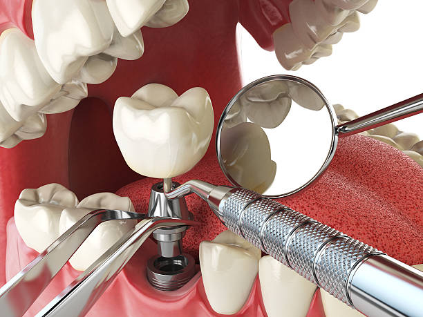 Best Emergency Wisdom Tooth Extraction in Walkertown, NC